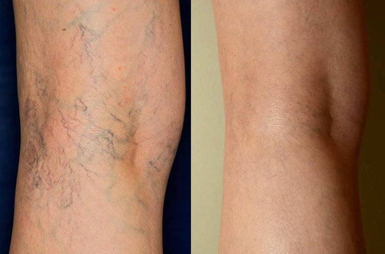 Spider Vein Sclerotherapy