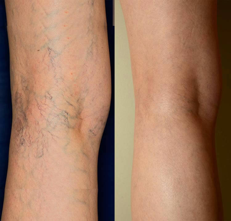 Reduction of spider veins on lower legs after sclerotherapy treatment.