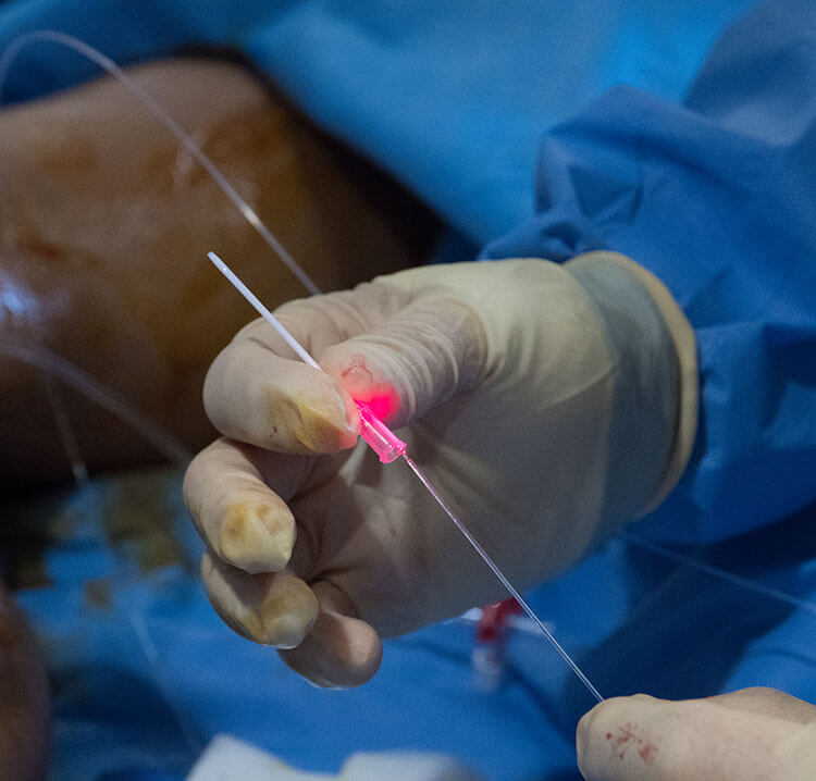 Surgeon preparing for treatment of abnormal leg vein with endovenous laser treatment.
