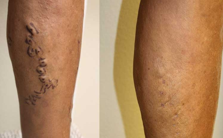 Reduction in abnormal, bulging leg veins after microphlebectomy treatment.