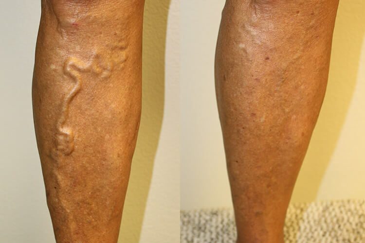 Microphlebectomy Procedure for Varicose Veins