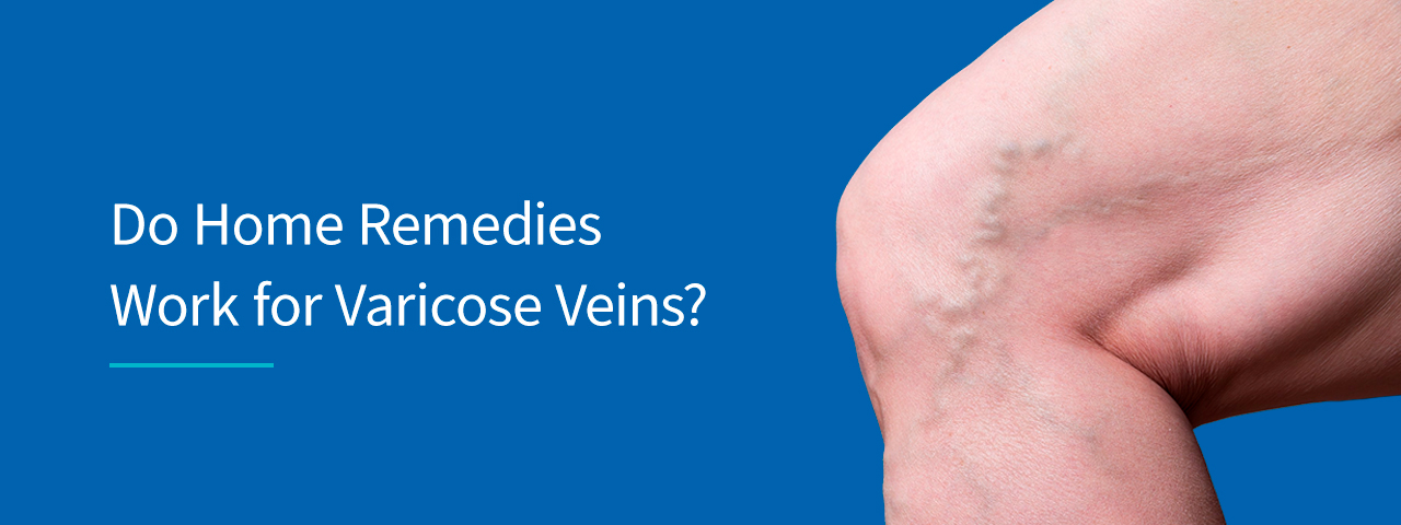 Do Home Remedies Work for Varicose Veins?