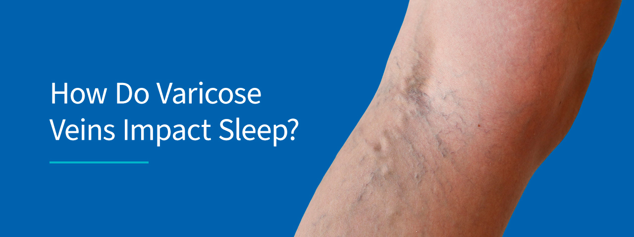 How Do Varicose Veins Impact Sleep?
