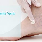 What Are Spider Veins?
