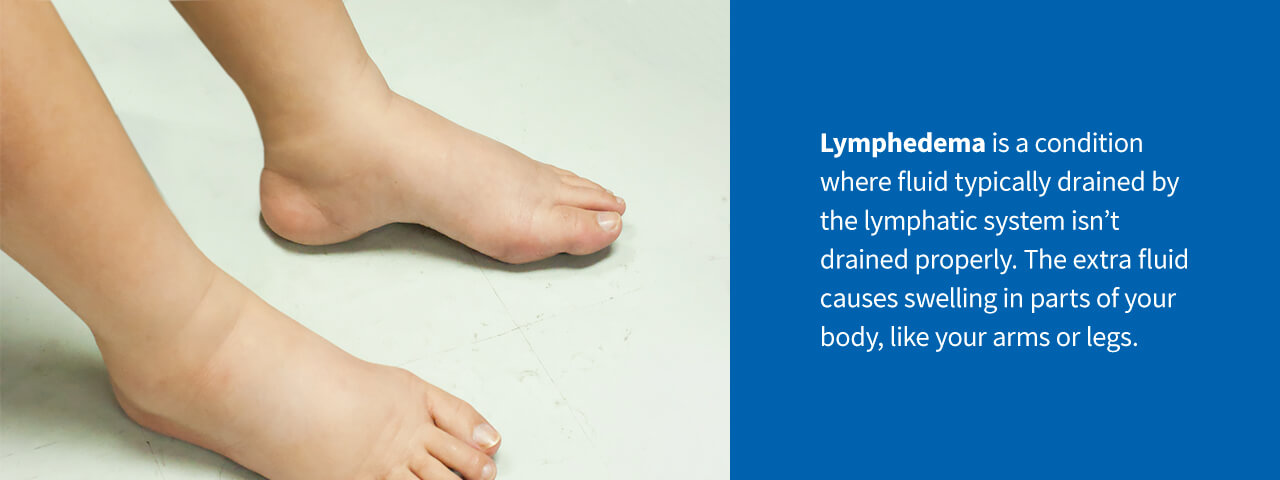 Lymphedema — Pathophysiology, Appearance, Treatments and Association With Venous  Disease