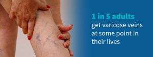 1 in 5 adults get varicose veins