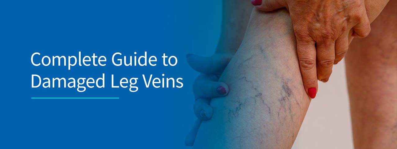 01-Complete-guide-to-damaged-leg-veins