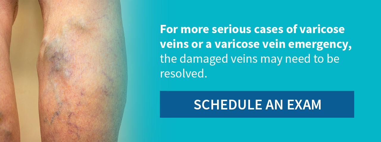 Treatment may be needed for serious cases of varicose veins