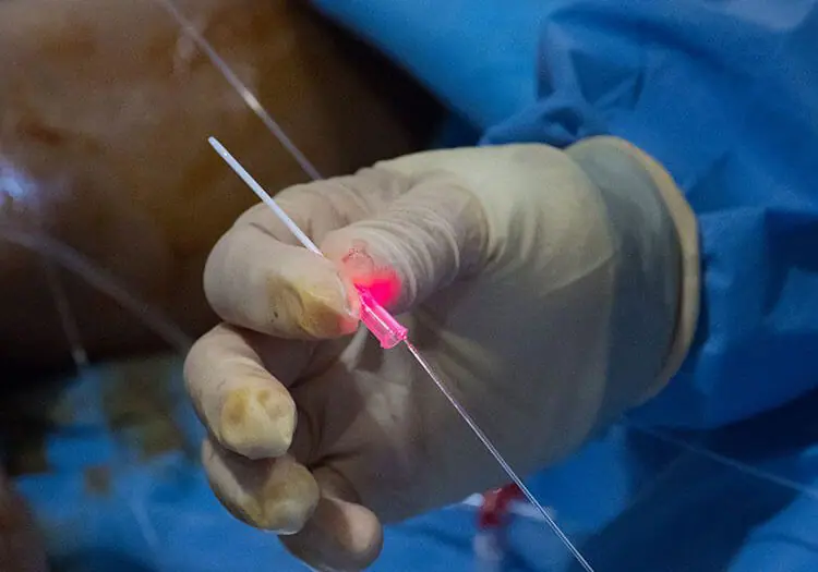 Doctor prepping for endovenous laser treatment