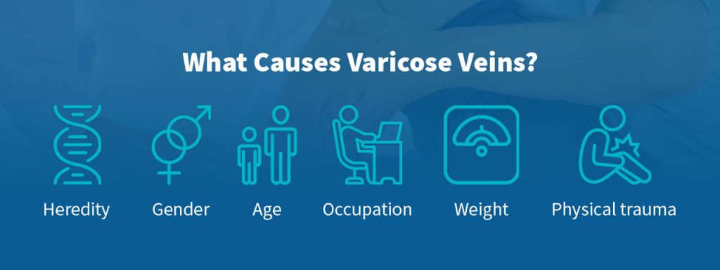 Causes of varicose veins