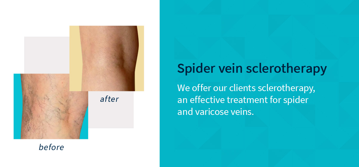 Spider vein sclerotherapy before and after