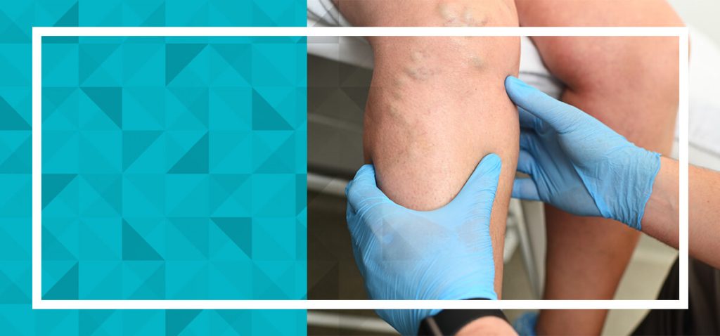 An Updated Guide to VenaSeal - Central Florida Vein