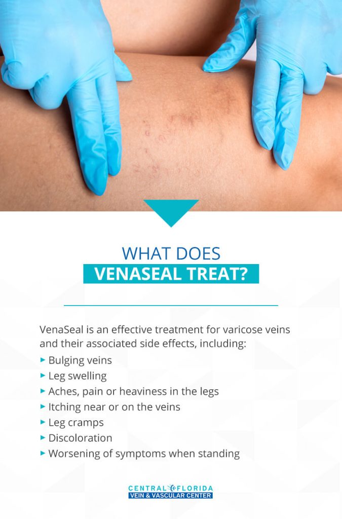 Venax Injection An Updated Guide to VenaSeal - Central Florida Vein