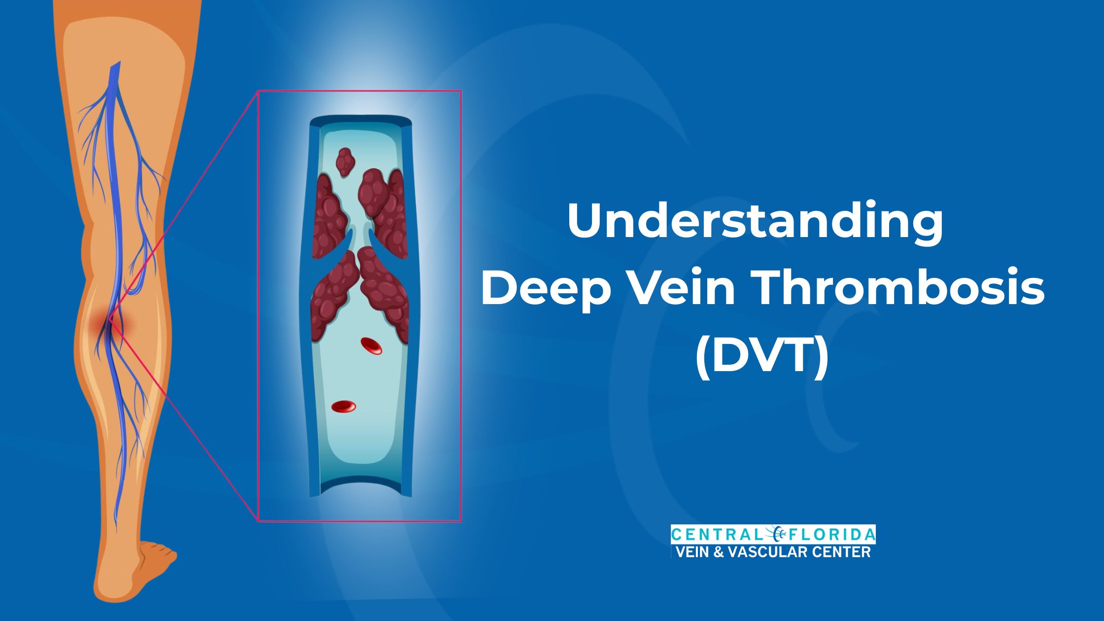 Understand Deep Vein Thrombosis | DVT Symptoms & Treatment